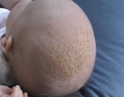Arp i hårbunden på din lille baby? Se her, hvad du kan gøre!